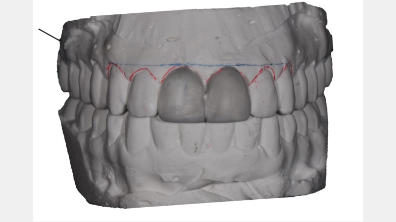 A Guide to Pre-Prep Diagnostic Mock-Ups Bonk guide pre prep diagnostic mock ups 04 1