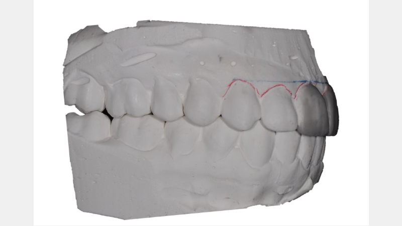 A Guide to Pre-Prep Diagnostic Mock-Ups Bonk guide pre prep diagnostic mock ups 05 1