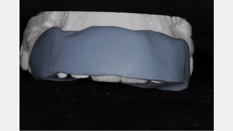 A Guide to Pre-Prep Diagnostic Mock-Ups Bonk guide pre prep diagnostic mock ups 06 1