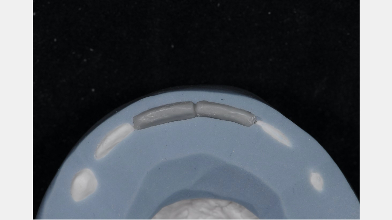 A Guide to Pre-Prep Diagnostic Mock-Ups Bonk guide pre prep diagnostic mock ups 07 1