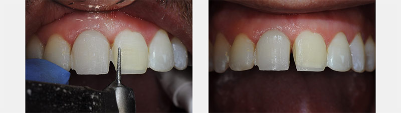 A Guide to Pre-Prep Diagnostic Mock-Ups Bonk guide pre prep diagnostic mock ups 08 1