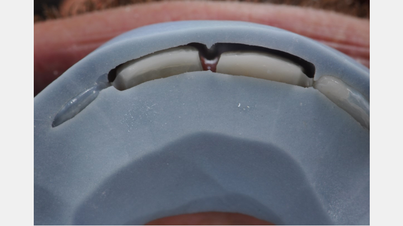 A Guide to Pre-Prep Diagnostic Mock-Ups Bonk guide pre prep diagnostic mock ups 09 1