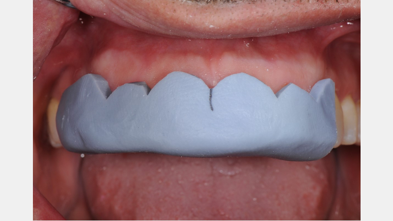 A Guide to Pre-Prep Diagnostic Mock-Ups Bonk guide pre prep diagnostic mock ups 10 1