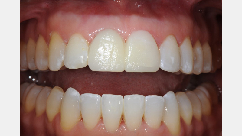 A Guide to Pre-Prep Diagnostic Mock-Ups Bonk guide pre prep diagnostic mock ups 11 1