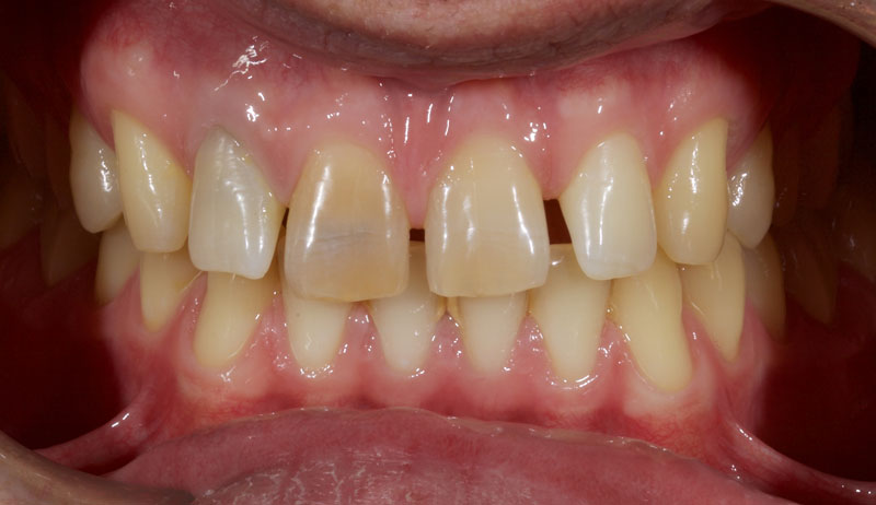 Restoration of the Peg Lateral: The Direct Resin Approach Smithson restoration lateral peg 01 2