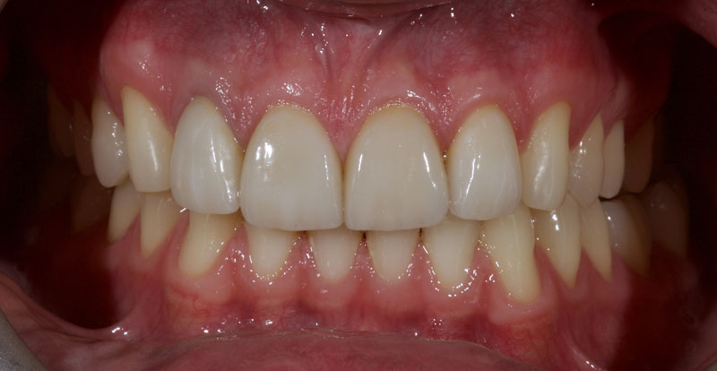 Restoration of the Peg Lateral: The Direct Resin Approach Smithson restoration lateral peg 02 1