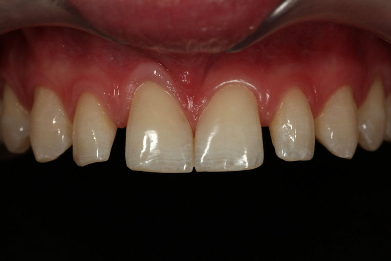 Restoration of the Peg Lateral: The Direct Resin Approach Smithson restoration lateral peg 03