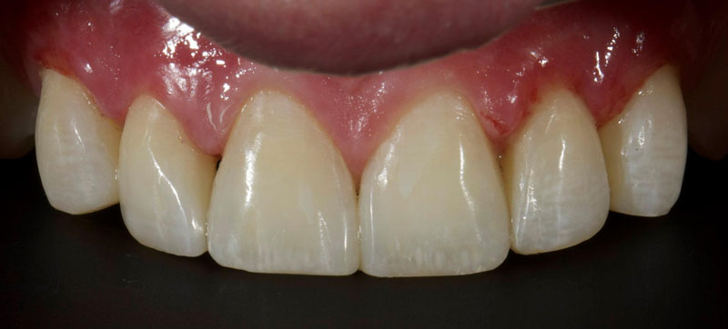 Restoration of the Peg Lateral: The Direct Resin Approach Smithson restoration lateral peg 04