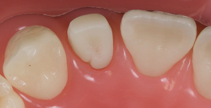 Restoration of the Peg Lateral: The Direct Resin Approach Smithson restoration lateral peg 05