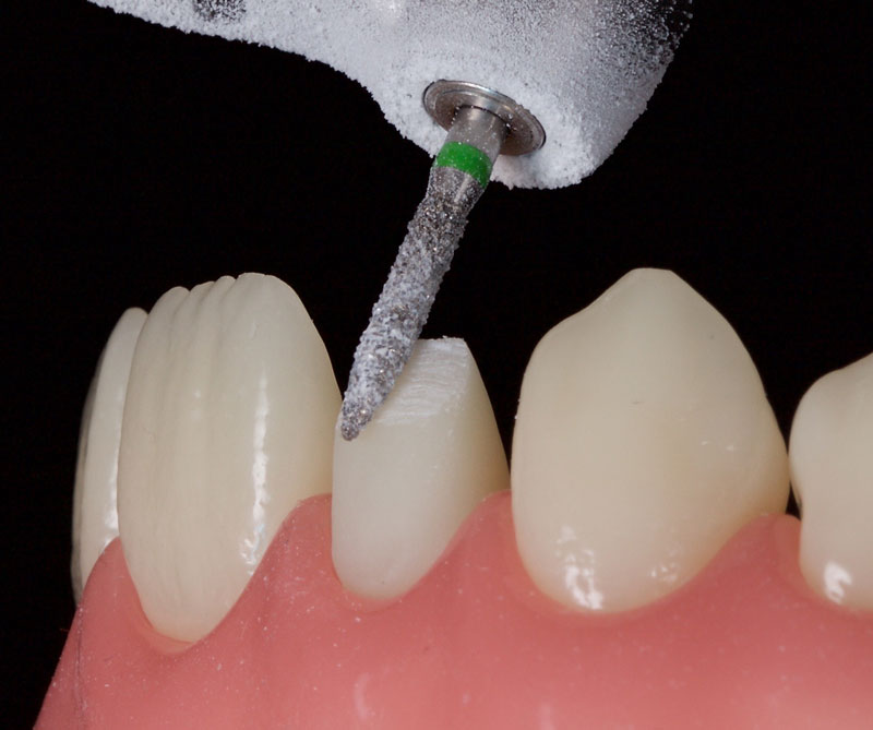 Restoration of the Peg Lateral: The Direct Resin Approach Smithson restoration lateral peg 06