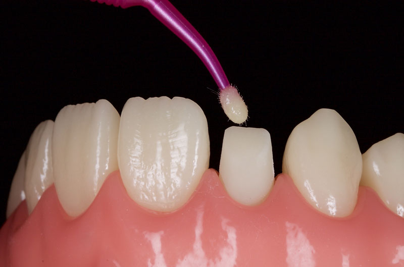 Restoration of the Peg Lateral: The Direct Resin Approach Smithson restoration lateral peg 07