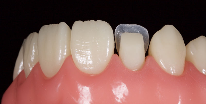Restoration of the Peg Lateral: The Direct Resin Approach Smithson restoration lateral peg 08