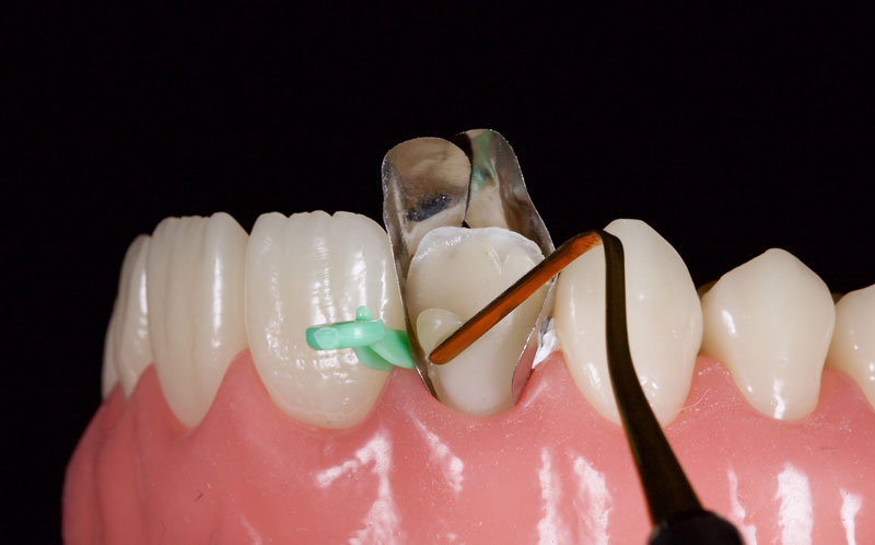 Restoration of the Peg Lateral: The Direct Resin Approach Smithson restoration lateral peg 09