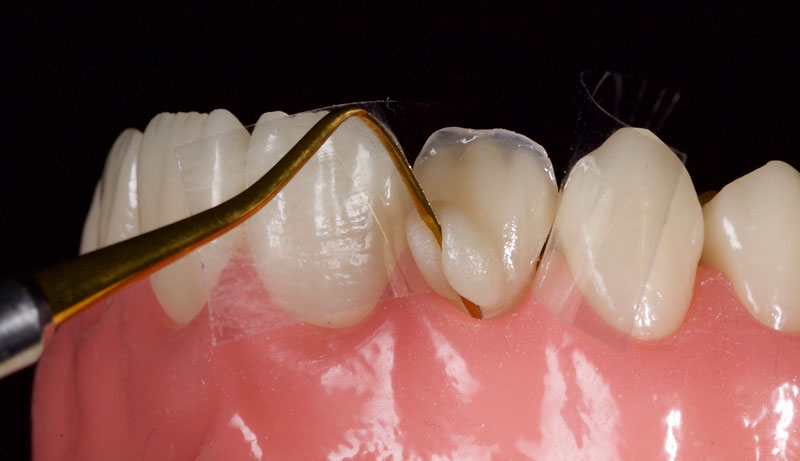 Restoration of the Peg Lateral: The Direct Resin Approach Smithson restoration lateral peg 10