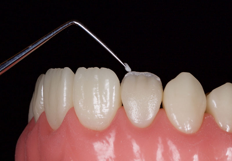Restoration of the Peg Lateral: The Direct Resin Approach Smithson restoration lateral peg 11