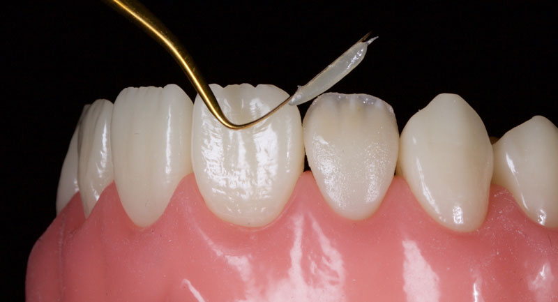 Restoration of the Peg Lateral: The Direct Resin Approach Smithson restoration lateral peg 13