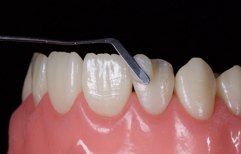 Restoration of the Peg Lateral: The Direct Resin Approach Smithson restoration lateral peg 14