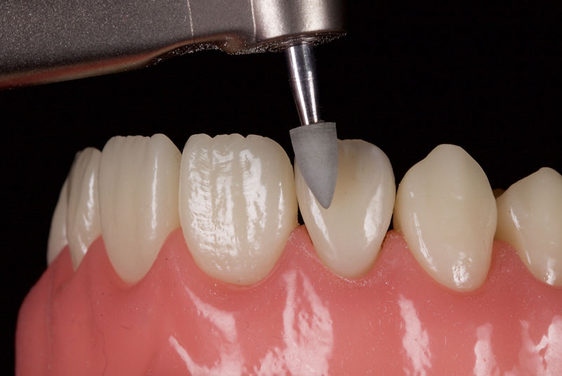 Restoration of the Peg Lateral: The Direct Resin Approach Smithson restoration lateral peg 15