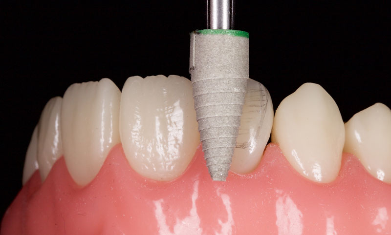 Restoration of the Peg Lateral: The Direct Resin Approach Smithson restoration lateral peg 16