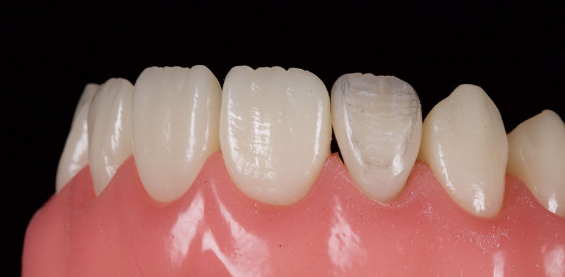 Restoration of the Peg Lateral: The Direct Resin Approach Smithson restoration lateral peg 17