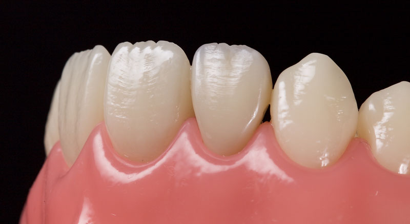 Restoration of the Peg Lateral: The Direct Resin Approach Smithson restoration lateral peg 18