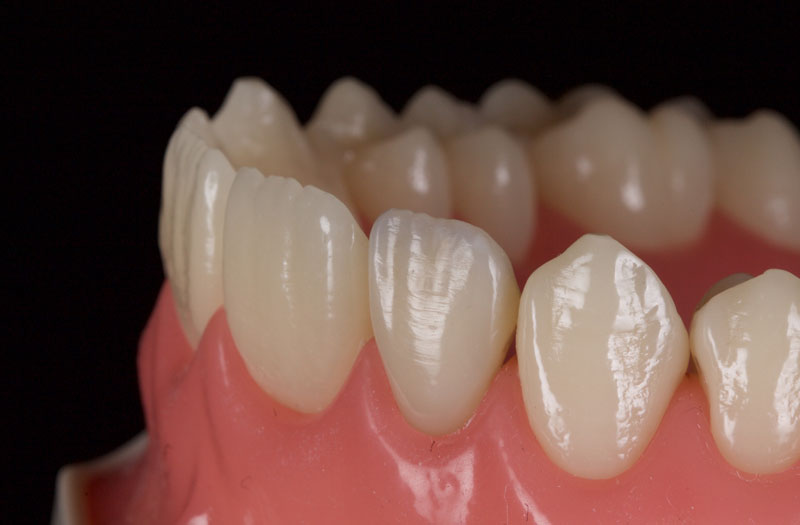 Restoration of the Peg Lateral: The Direct Resin Approach Smithson restoration lateral peg 19