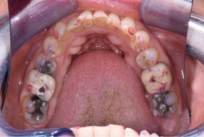 Some Questions I’ve Been Asked About Occlusion Over the Years Steinberg some questions ive been asked 01