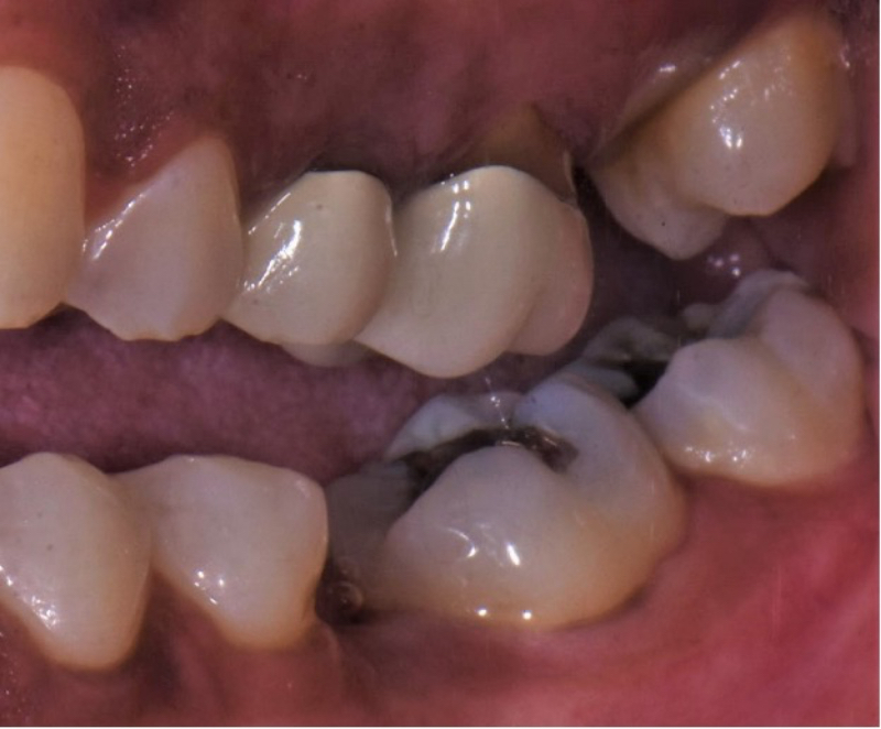 Some Questions I’ve Been Asked About Occlusion Over the Years Steinberg some questions ive been asked 02