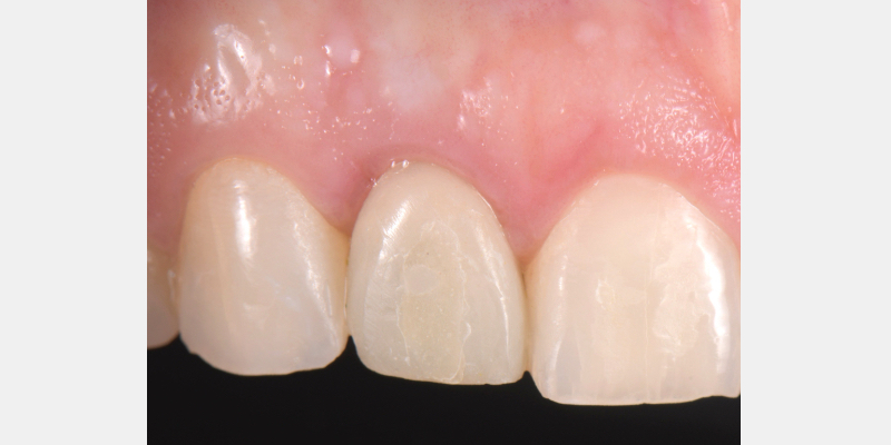 Silicone Jig Technique for Cement-Retained Implant Supported Restoration Mitrani silicone jig technique for cement 01