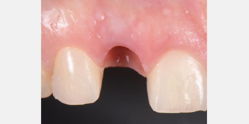 Silicone Jig Technique for Cement-Retained Implant Supported Restoration Mitrani silicone jig technique for cement 02