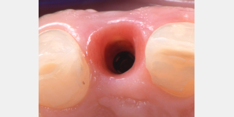 Silicone Jig Technique for Cement-Retained Implant Supported Restoration Mitrani silicone jig technique for cement 03