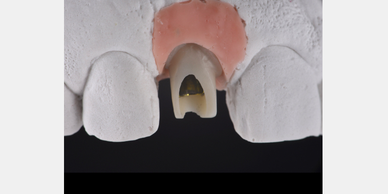 Silicone Jig Technique for Cement-Retained Implant Supported Restoration Mitrani silicone jig technique for cement 04