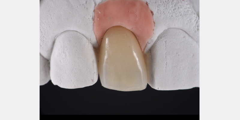Silicone Jig Technique for Cement-Retained Implant Supported Restoration Mitrani silicone jig technique for cement 05