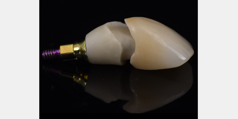 Silicone Jig Technique for Cement-Retained Implant Supported Restoration Mitrani silicone jig technique for cement 06