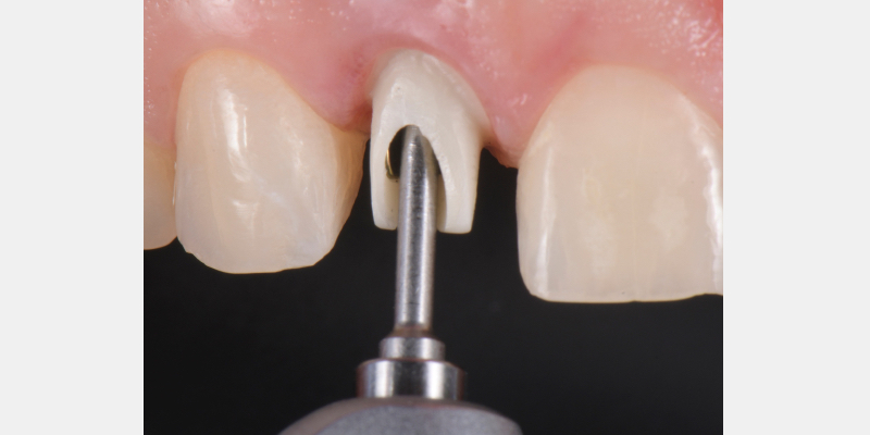Silicone Jig Technique for Cement-Retained Implant Supported Restoration Mitrani silicone jig technique for cement 07