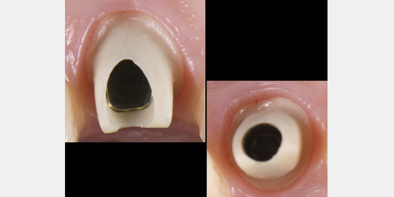 Silicone Jig Technique for Cement-Retained Implant Supported Restoration Mitrani silicone jig technique for cement 08