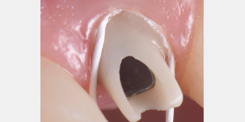 Silicone Jig Technique for Cement-Retained Implant Supported Restoration Mitrani silicone jig technique for cement 09