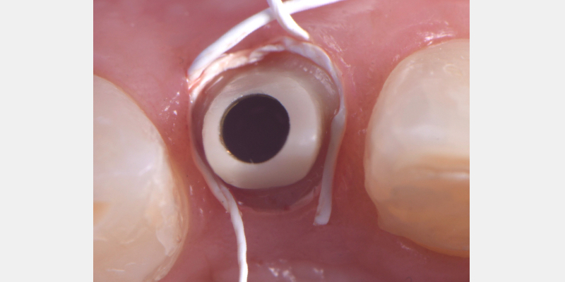 Silicone Jig Technique for Cement-Retained Implant Supported Restoration Mitrani silicone jig technique for cement 10