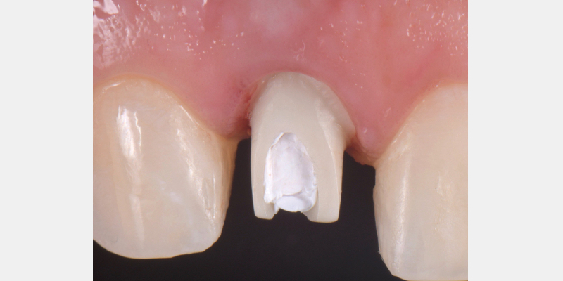 Silicone Jig Technique for Cement-Retained Implant Supported Restoration Mitrani silicone jig technique for cement 11