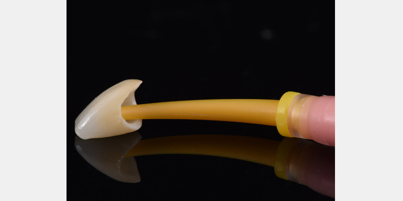 Silicone Jig Technique for Cement-Retained Implant Supported Restoration Mitrani silicone jig technique for cement 12