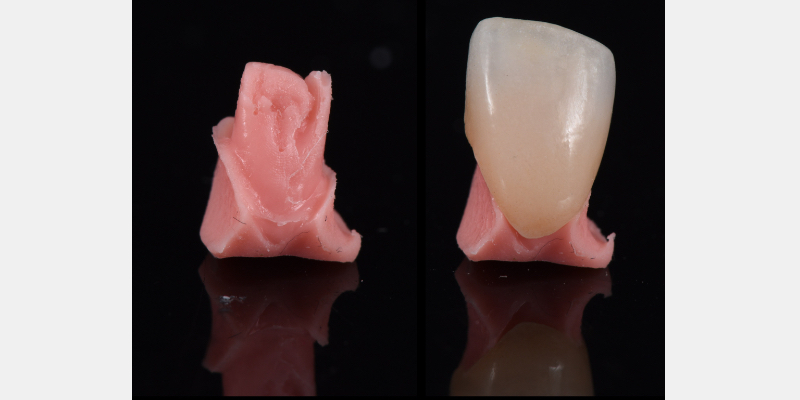 Silicone Jig Technique for Cement-Retained Implant Supported Restoration Mitrani silicone jig technique for cement 13