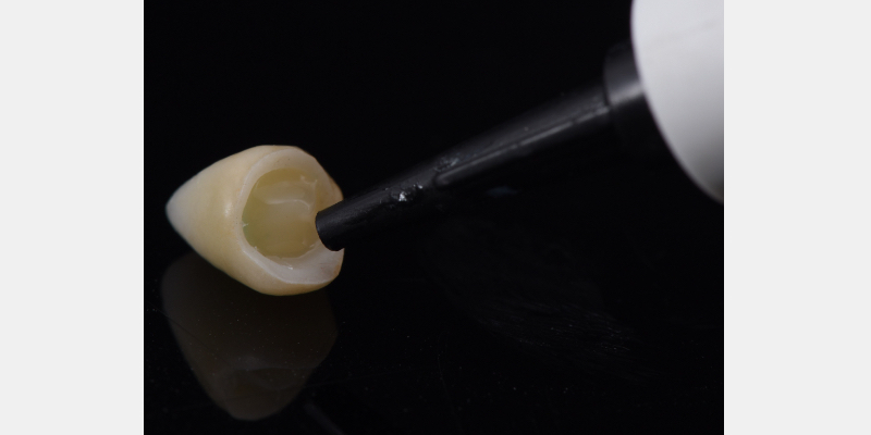 Silicone Jig Technique for Cement-Retained Implant Supported Restoration Mitrani silicone jig technique for cement 14