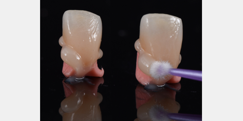 Silicone Jig Technique for Cement-Retained Implant Supported Restoration Mitrani silicone jig technique for cement 15