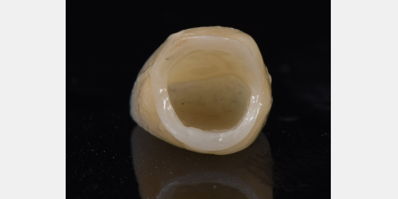 Silicone Jig Technique for Cement-Retained Implant Supported Restoration Mitrani silicone jig technique for cement 16