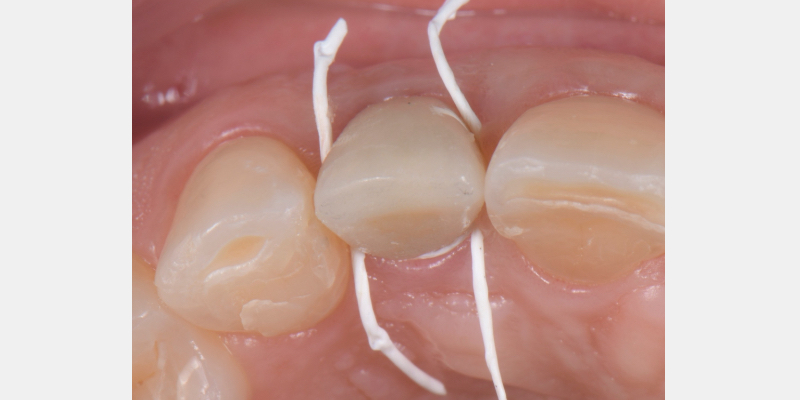 Silicone Jig Technique for Cement-Retained Implant Supported Restoration Mitrani silicone jig technique for cement 17