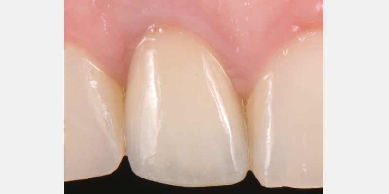 Silicone Jig Technique for Cement-Retained Implant Supported Restoration Mitrani silicone jig technique for cement 18
