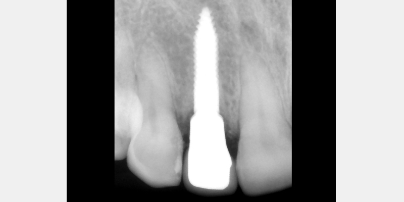 Silicone Jig Technique for Cement-Retained Implant Supported Restoration Mitrani silicone jig technique for cement 19