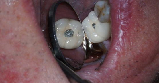 Loose implant crown with exposed screw access during evaluation of a cement-retained implant restoration.