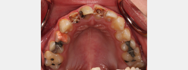 An Introduction to Silver Diamine Fluoride Janiga introduction to silver fluoride 01