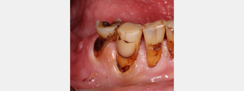 An Introduction to Silver Diamine Fluoride Janiga introduction to silver fluoride 04